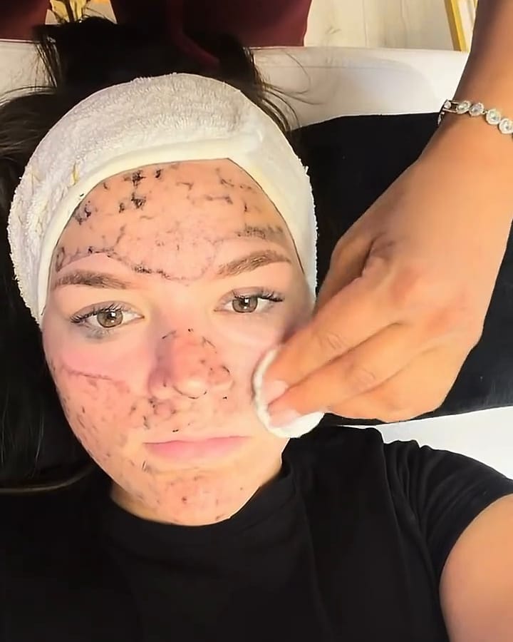 Posle lasera: uklanjanje maske vatom